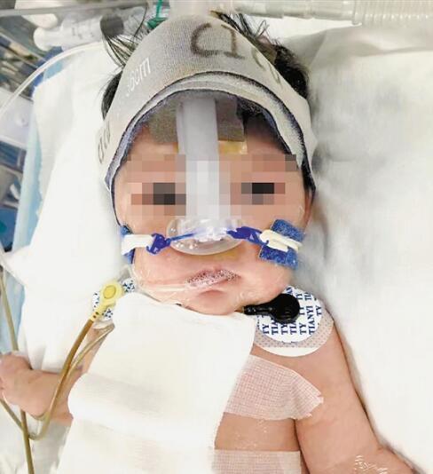 杭州1宝宝生下来只有半个心脏 上个月已完成首次手术