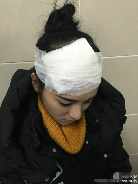 “武大校花”黄灿灿被曝拍戏时出意外 大灯砸中头部
